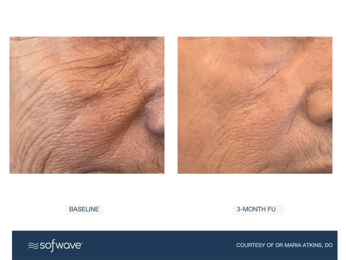 Sofwave™ The Brow and Eye Package